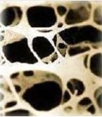 Figuur 2. Botstructuur bij osteoporose